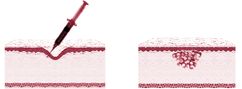 Injection of Bulking Agent into Dermis